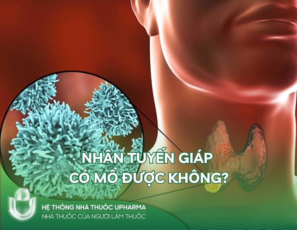 Nhân tuyến giáp có mổ được không?